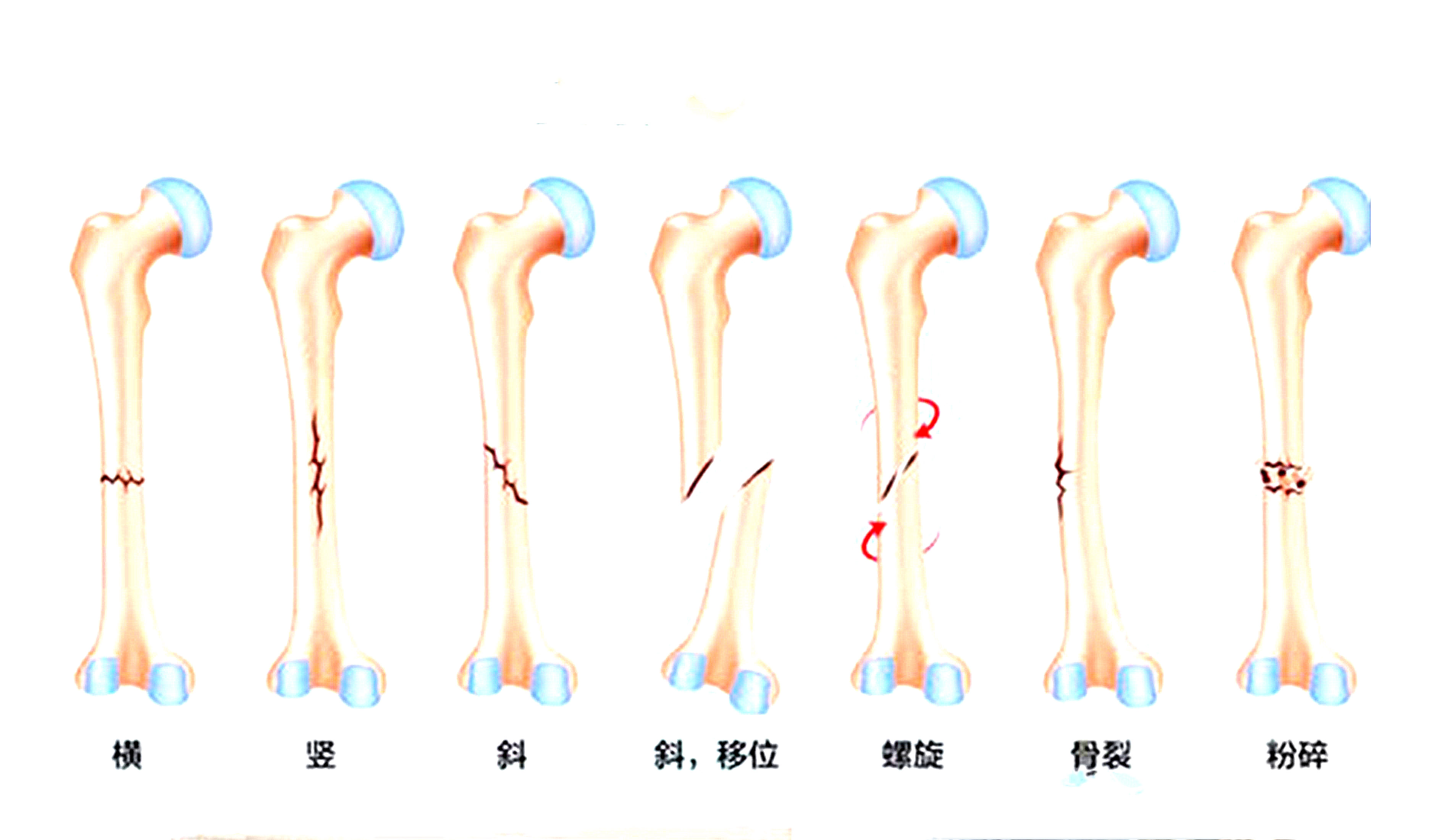 骨裂是骨折嗎？